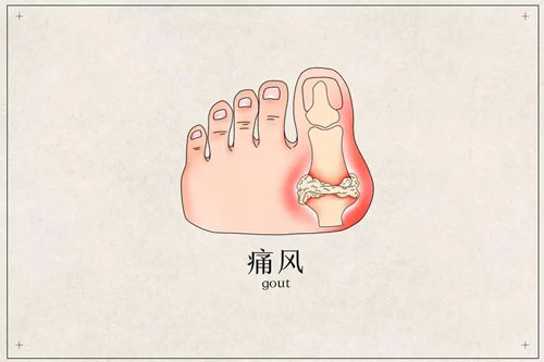 女性痛风怎么引起的
